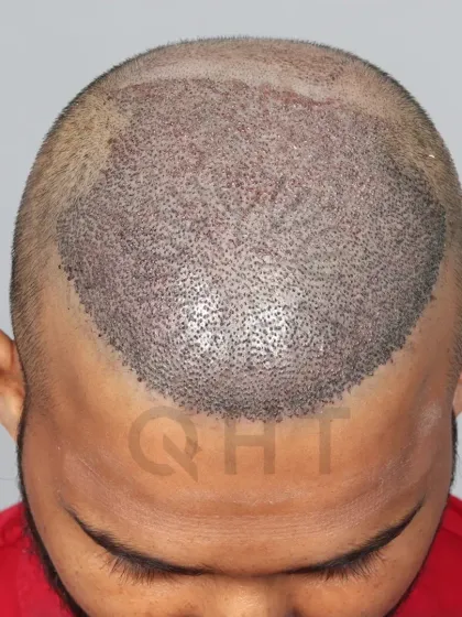 High-density, high-impact. 5000 grafts placed to restore the hairline and mid-scalp for a powerful comeback.