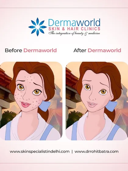 Every skin journey is unique, but the goal is always the same: to feel confident and beautiful. This shows the transformation from dealing with breakouts to enjoying clear, healthy skin. With the right treatment plan, this is achievable for everyone.
