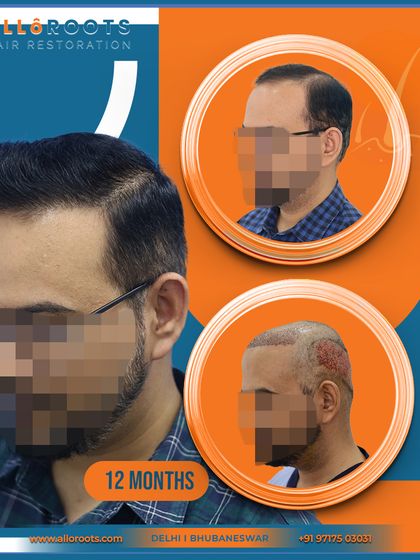 A 12-month transformation showing the before, post-op, and final result. This collage format gives a quick yet comprehensive overview of the patient's successful journey.