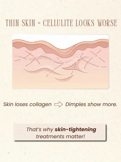 When skin loses collagen and becomes thinner, the dimples from cellulite can look worse. This is why skin-tightening treatments are a crucial part of an effective cellulite reduction plan.