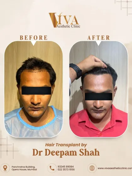 A fantastic 7-month result for a patient with Grade 2 hair loss. With just 1800 grafts, we reinforced his hairline and added density, giving him a fuller look and stopping further recession.