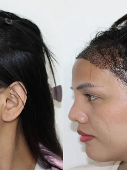 The profile view demonstrates the new, lower starting point of the hairline. I take great care to create a soft, irregular line that mimics natural female hairlines.