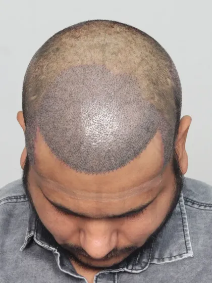 This shows the crucial first step: hairline design. We mark the area precisely to ensure the final result perfectly frames the face.