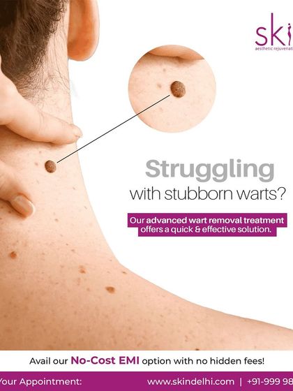 Laser Removal: Moles, Warts & Tags photo 4