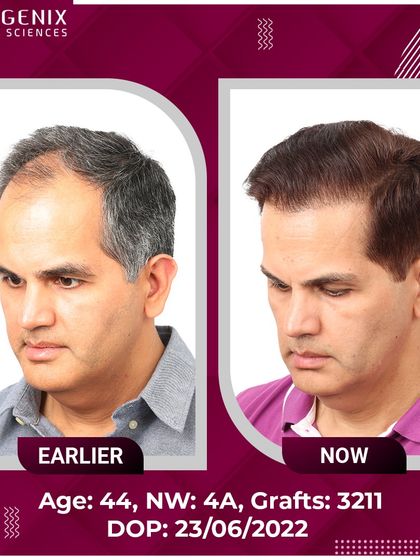 Real results for real people: a 44-year-old's successful 3211-graft transplant.