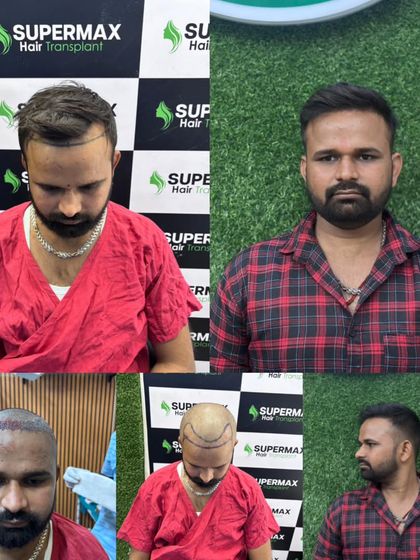 A 6.5-month journey with 6000 grafts. This collage shows the different stages, from pre-op marking to the final impressive result.