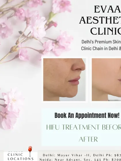 A direct comparison showcasing the results of our HIFU treatment. Notice the visible skin tightening and lifting effect, which helps redefine the jawline and reduce the appearance of sagging.