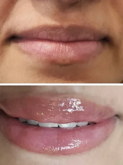 This before-and-after showcases a complete lip transformation. I neutralized the initial uneven pigmentation and cool tones, then applied a vibrant, healthy pink blush. The result is fuller, more defined lips with a glossy finish that looks fresh and youthful, eliminating the daily need for lipstick.