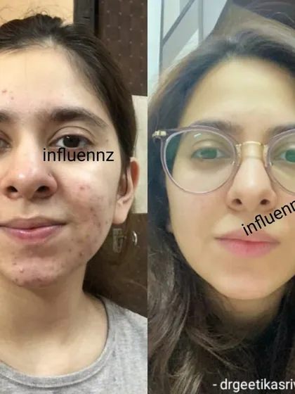 This transformation is a perfect example of a comprehensive acne management plan. We worked together to control breakouts and then addressed the marks left behind. The result is not just clearer skin, but a renewed sense of self.