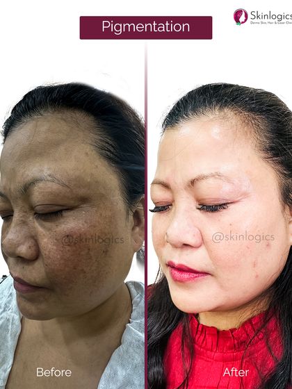 A side view ângulo of a patient's pigmentation treatment. The 'before' shows dark, patchy skin, while the 'after' reveals a significantly brighter and more even complexion.