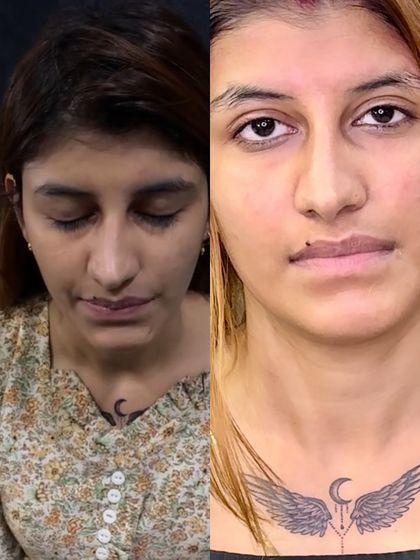 Another successful Korean Whitening Treatment. Notice how the treatment not only brightened her overall complexion but also improved the skin's texture, giving it a smoother and more youthful appearance.