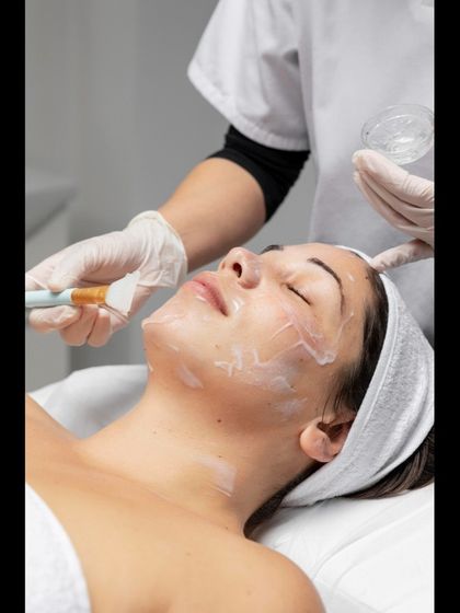 This image shows a chemical peel application. I carefully select the type and strength of the peel based on your skin type and concern to ensure a safe treatment with visible renewal.