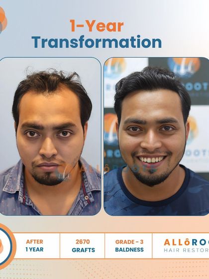 After one year, this patient's Grade 3 baldness was fully addressed with 2670 grafts. The transformation is evident in his smile and the natural, dense hairline that frames his face.