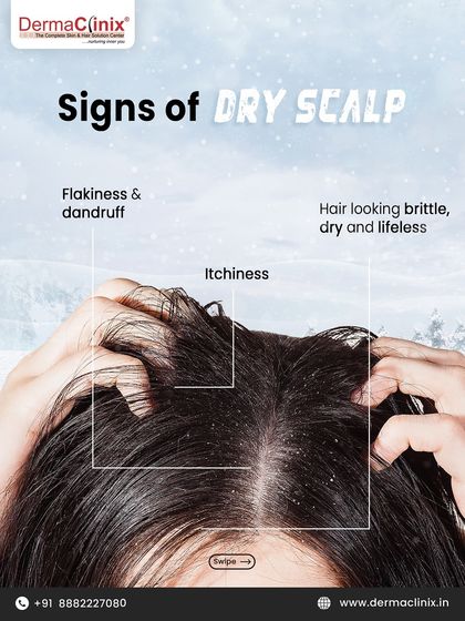 Here are the common signs of a dry scalp to watch out for in winter: flakiness, dandruff, itchiness, and hair that looks brittle and lifeless.