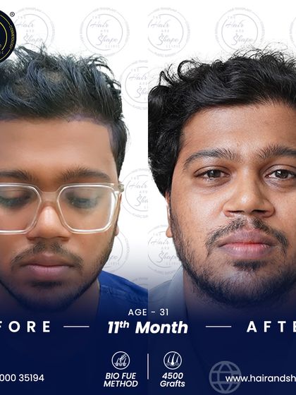 This frontal view at 11 months shows the complete and mature result of a high-graft BIO FUE procedure.