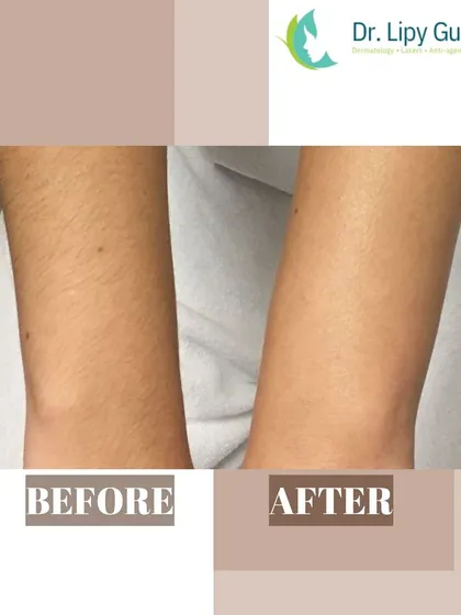See the difference laser hair reduction can make on the arms. The 'before' image shows dense hair growth, while the 'after' image displays smooth, hair-free skin, demonstrating the effectiveness of targeting hair at the follicle level for long-lasting results.