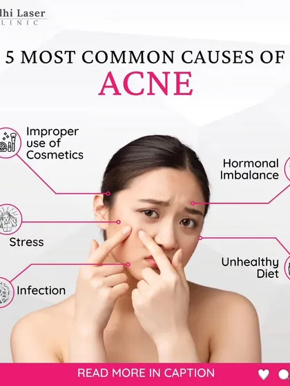 Understanding the root cause of acne is the first step to treating it effectively. This guide breaks down the five most common triggers I see in my clinic, from hormonal imbalances to improper use of cosmetics.