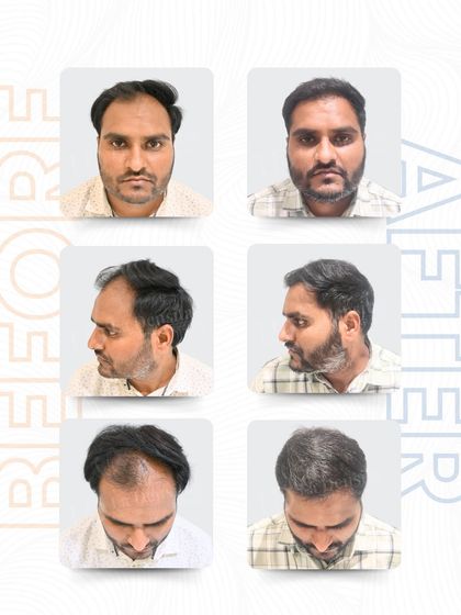 This multi-angle view shows Siddhant's complete hair transplant transformation. You can see how the 3,496 grafts created a fuller hairline and added density across the scalp for a natural and balanced result.