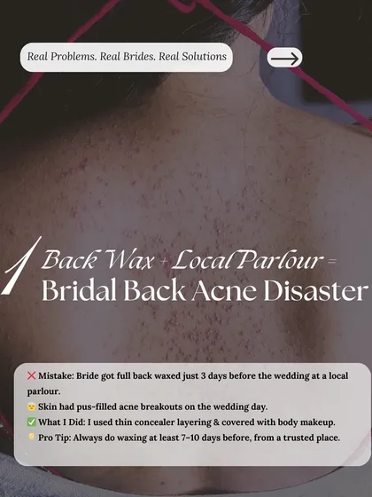 Bridal Emergency 1: Back acne from a bad wax. Pro tip: Always get waxing done at least 7-10 days before your wedding from a trusted salon to avoid last-minute breakouts.