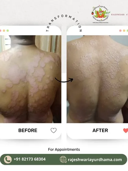 Here you can see the transformative results of my Ayurvedic treatment for a chronic skin condition on the back. My holistic approach focuses on addressing the root cause of skin issues, leading to lasting relief and visibly healthier skin.