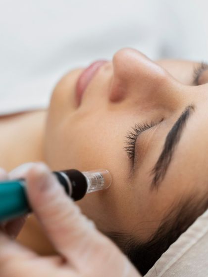 Here, a patient is undergoing an MNRF treatment. This advanced procedure is excellent for skin tightening and scar reduction, as it combines the benefits of microneedling with the collagen-boosting power of radiofrequency energy.