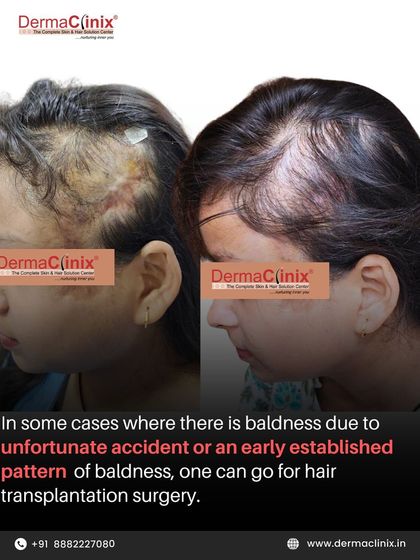 This image shows a successful hair transplant for a patient who experienced baldness due to an unfortunate accident. In such cases, surgery can be a viable option to restore hair and cover scar tissue.