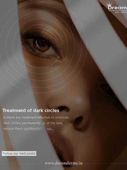 Are you looking for an effective treatment to eliminate or significantly reduce dark circles? We have the expertise to transform tired eyes into vibrant ones. Follow our page for more information on our solutions.