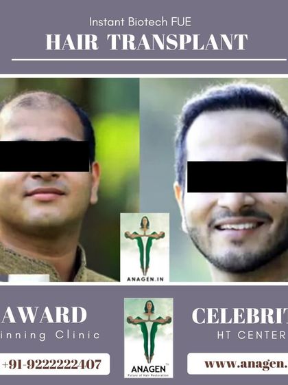 This patient's transformation from Grade 6 baldness is remarkable. The after photo shows a happy, confident man with a full, natural looking head of hair.