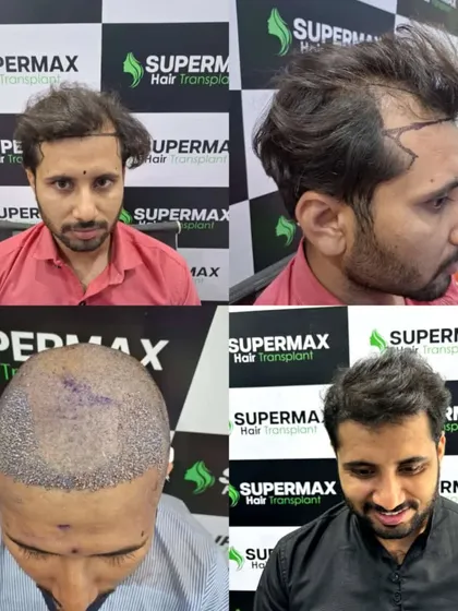 A 5-month result that shows the power of a professional hair transplant. The hairline is natural and the density is building up perfectly.