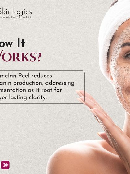 How does the Cosmelan Peel work? This graphic explains that the treatment works at the root of the problem by reducing melanin production, leading to longer-lasting skin clarity.