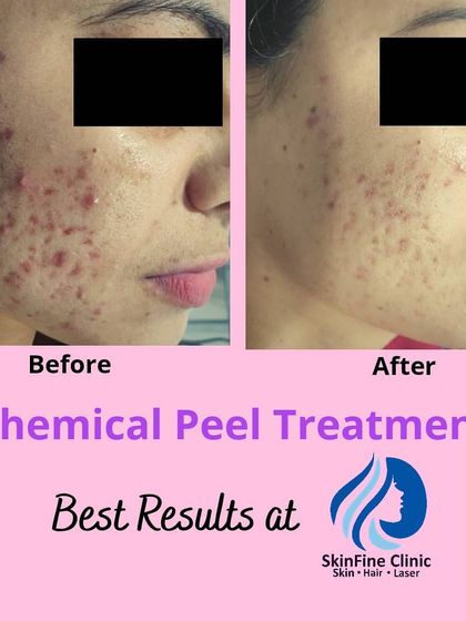 A before and after look at the results of chemical peel treatments for active acne and marks. After just two sessions, you can see a considerable reduction in inflammation and fading of post-acne pigmentation.