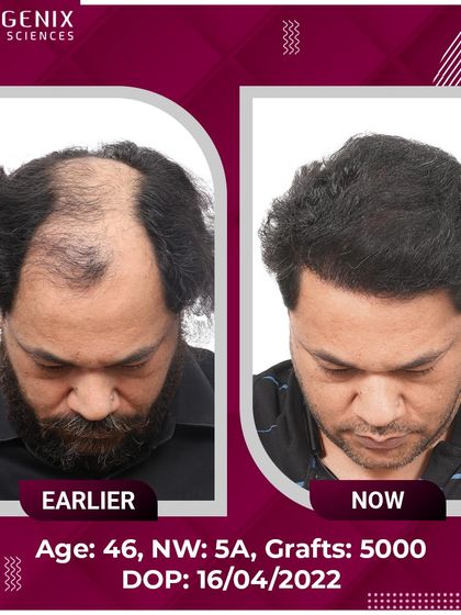 A remarkable 5000-graft transformation for a 46-year-old patient with Grade 5A baldness.