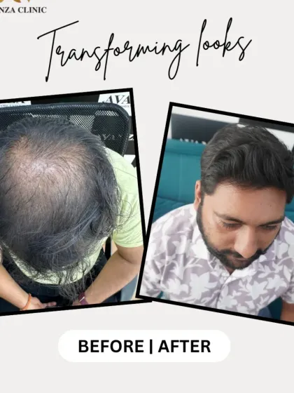 From thin and sparse to thick and full. This result was achieved by carefully placing grafts to maximize the appearance of volume and density across the top of the scalp.