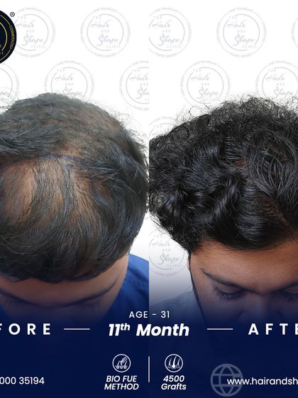 11 months after a 4500-graft BIO FUE transplant, the density and natural look of the hair are outstanding.