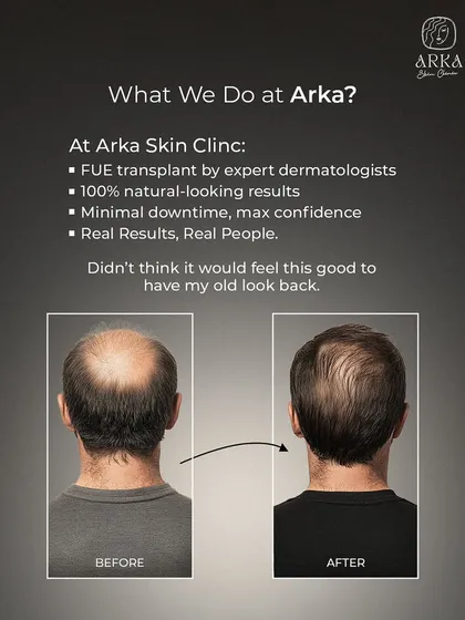 This is the kind of transformation that restores confidence. We achieved this full, natural-looking coverage using our advanced FUE hair transplant technique. The goal is always to create a result so seamless that it looks like you never lost any hair in the first place.