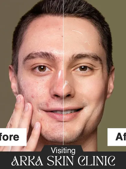 From breakouts to brilliance. This before-and-after image is a testament to the transformations that are possible when you visit Arka Skin Clinic. We turn skin problems into success stories.