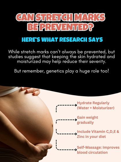 Can stretch marks be prevented? While genetics play a huge role, keeping your skin hydrated, gaining weight gradually, and getting key nutrients may help reduce their severity.