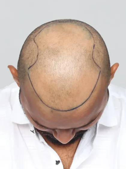 This shows the crucial first step: hairline design. We mark the area precisely to ensure the final result perfectly frames the face.