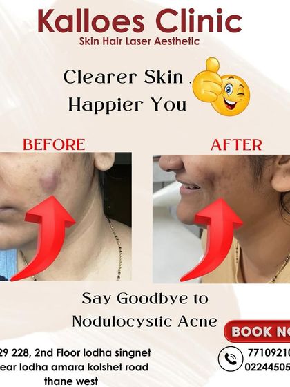 This is a case of nodulocystic acne, a severe form that requires prompt medical attention to prevent scarring. This "after" photo shows the dramatic reduction in inflammation and cysts after a course of prescribed treatment.