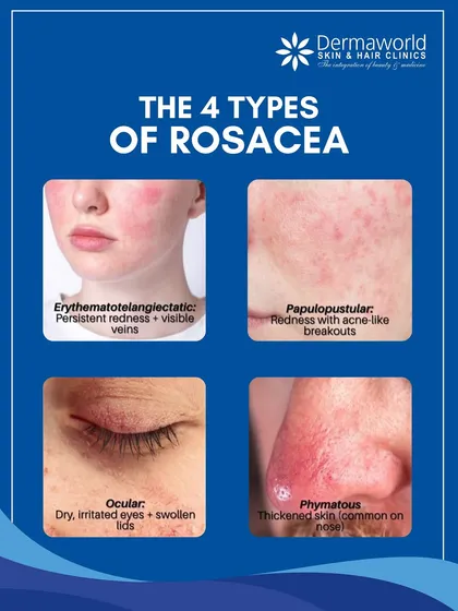 Did you know there are four different types of rosacea? They range from persistent redness and visible veins to acne-like breakouts and thickened skin, each requiring a unique, tailored treatment approach for effective management.