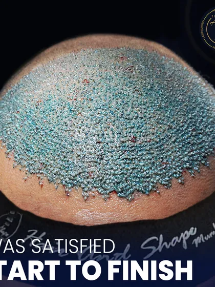 The art of hair transplantation lies in the details. This image shows the immediate result of a high-density transplant, where each follicle is meticulously placed to ensure a natural growth pattern and maximum coverage.