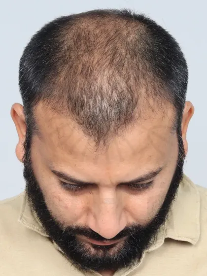 A 9-month result for a Diffuse Grade 6 patient. We used 4500 grafts to restore the hairline, frontal region, mid-scalp, and crown.