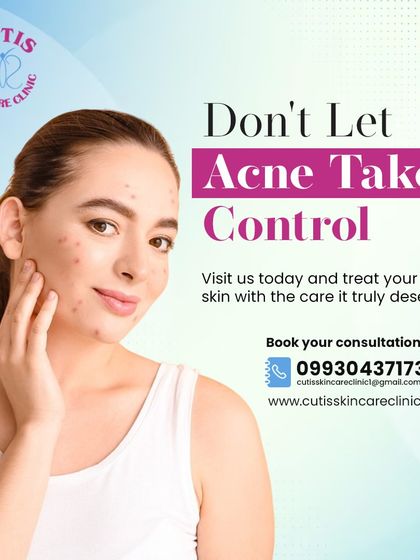 Don't let acne take control of your confidence. We provide the professional care your skin deserves, with personalized treatment plans designed by our expert dermatologists to help you achieve and maintain clear skin.