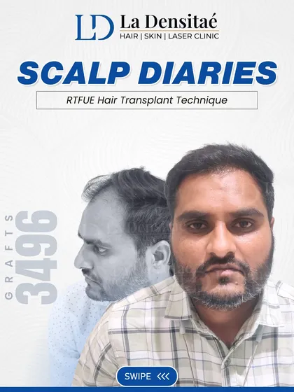 Siddhant just wanted to look like himself again. With 3,496 grafts and the RT-FUE technique, I helped him do just that. The result is simple and honest, a natural look that restored his confidence.