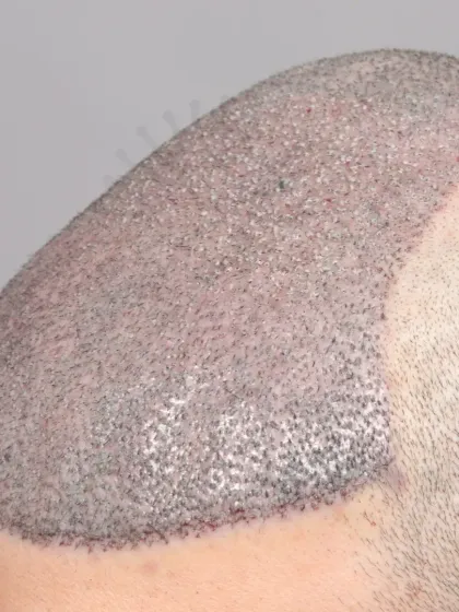 Another repair case for a Norwood Grade 6 patient. We used 5000 grafts to correct the previous work and provide a natural, dense result.