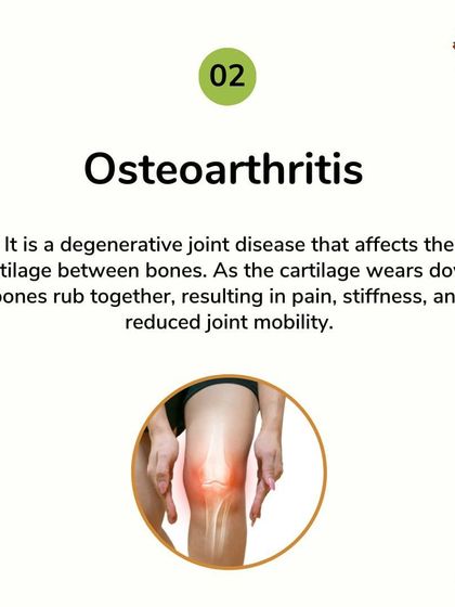 Osteoarthritis occurs when cartilage wears down, causing bones to rub together. My approach focuses on lubricating the joints and reducing inflammation to manage pain and slow the progression of this degenerative joint disease.