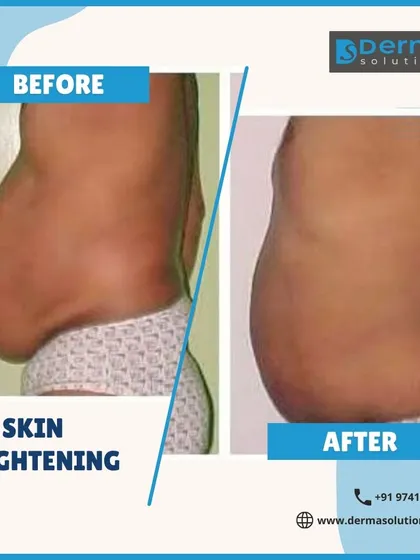 This before and after image shows the tangible results of my RF Skin Tightening treatment. You can see a significant reduction in abdominal skin laxity and a firmer, more toned appearance. This is achieved by using radiofrequency energy to stimulate your body's natural collagen production.