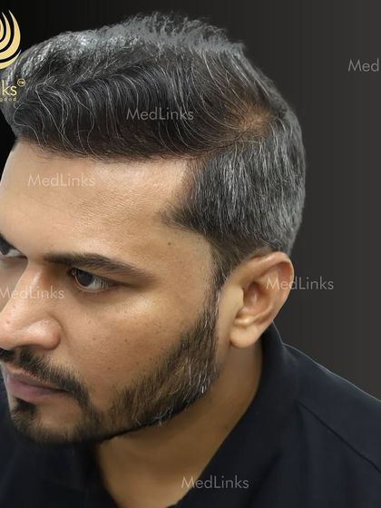 The final result from the side, showing a natural and dense hairline.