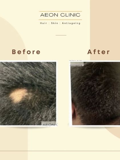 This image shows the successful treatment of alopecia areata, a condition causing patchy hair loss. Our targeted treatments helped this client achieve full regrowth in the affected area.
