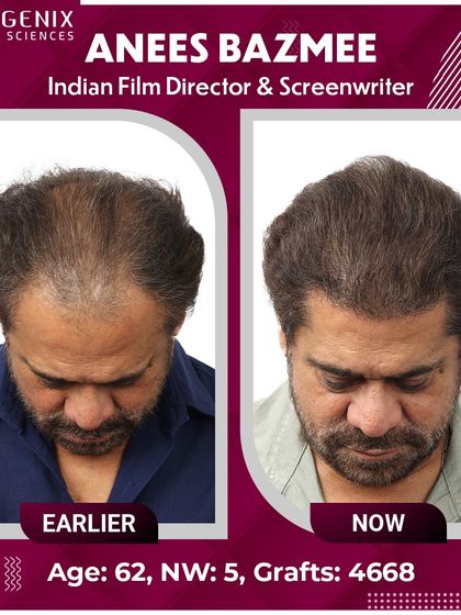 A complete view of Director Anees Bazmee's transformation from all angles, showing the density and natural hairline we created.
